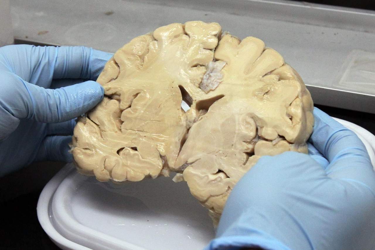 Servirá para entender lo que está pasando en el cerebro inmediatamente después de una lesión grave, una paso crucial para desarrollar tratamientos médicos más efectivos. (ARCHIVO)