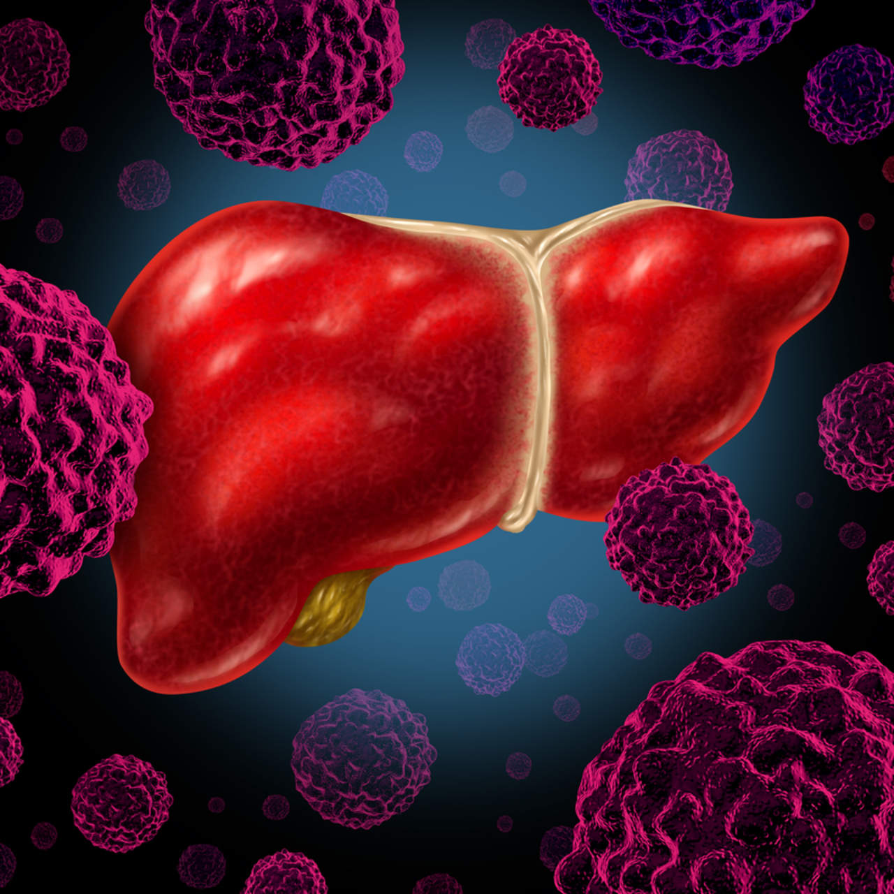 Obesidad y hepatitis aumentan incidencia de cáncer de hígado