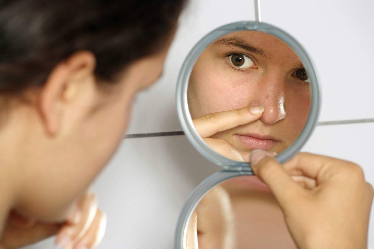 De no atenderse debidamente el acné deja cicatrices que pueden afectar el autoestima del joven. (ARCHIVO) 