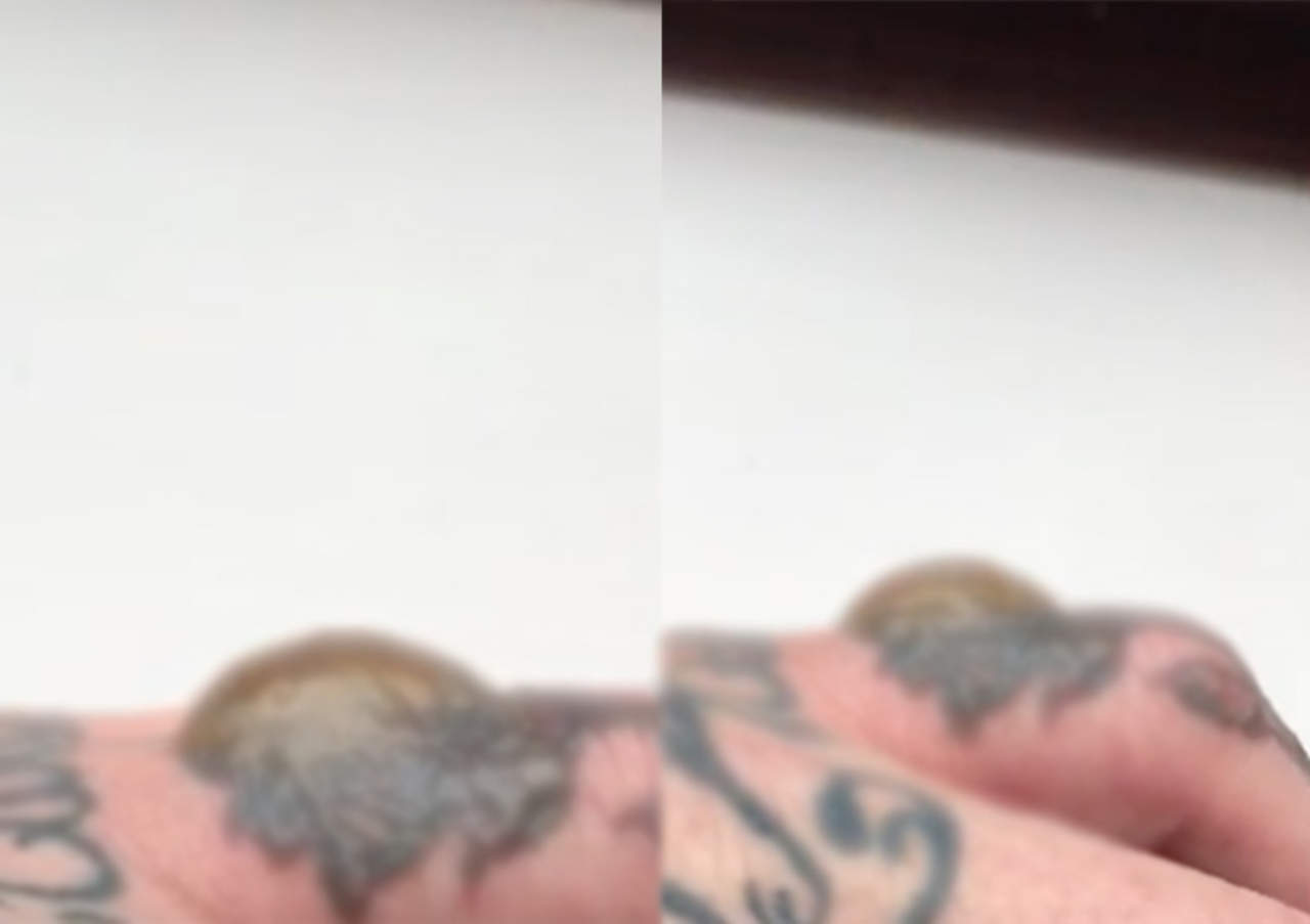 VIDEO: Decide quitarse tatuaje con láser y sufre reacción