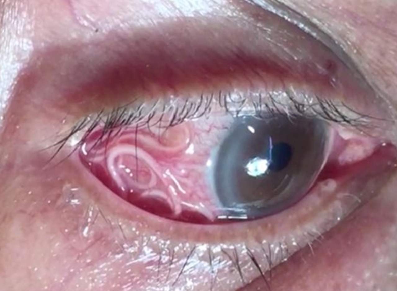 La longitud del gusano se midió hasta que fue extraído del ojo del paciente. (INTERNET)