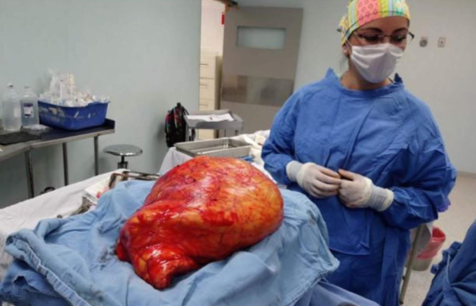 El tumor registró un peso de 17 kilos. (ESPECIAL) 