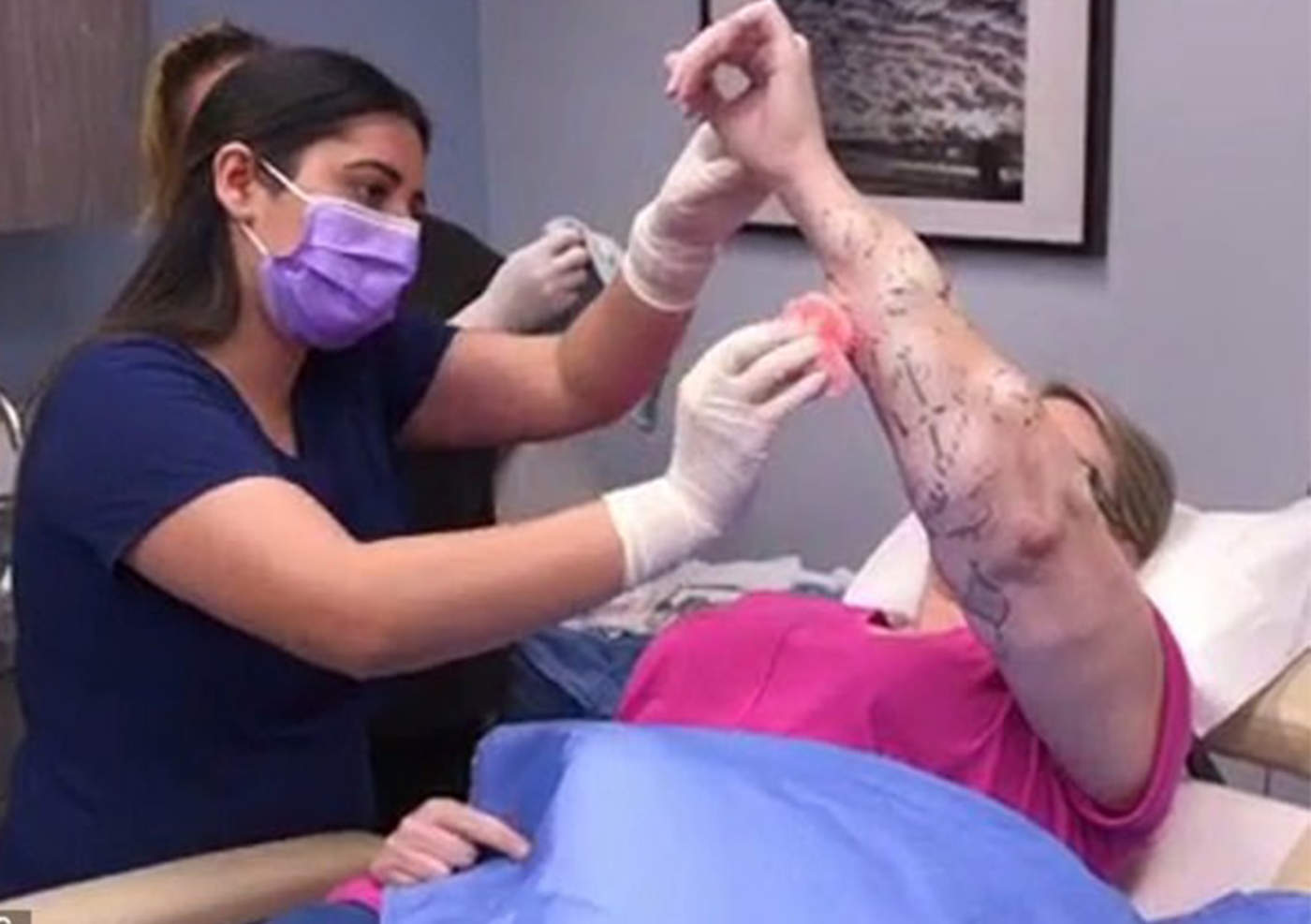 Logran retirar 68 linfomas de brazo de mujer