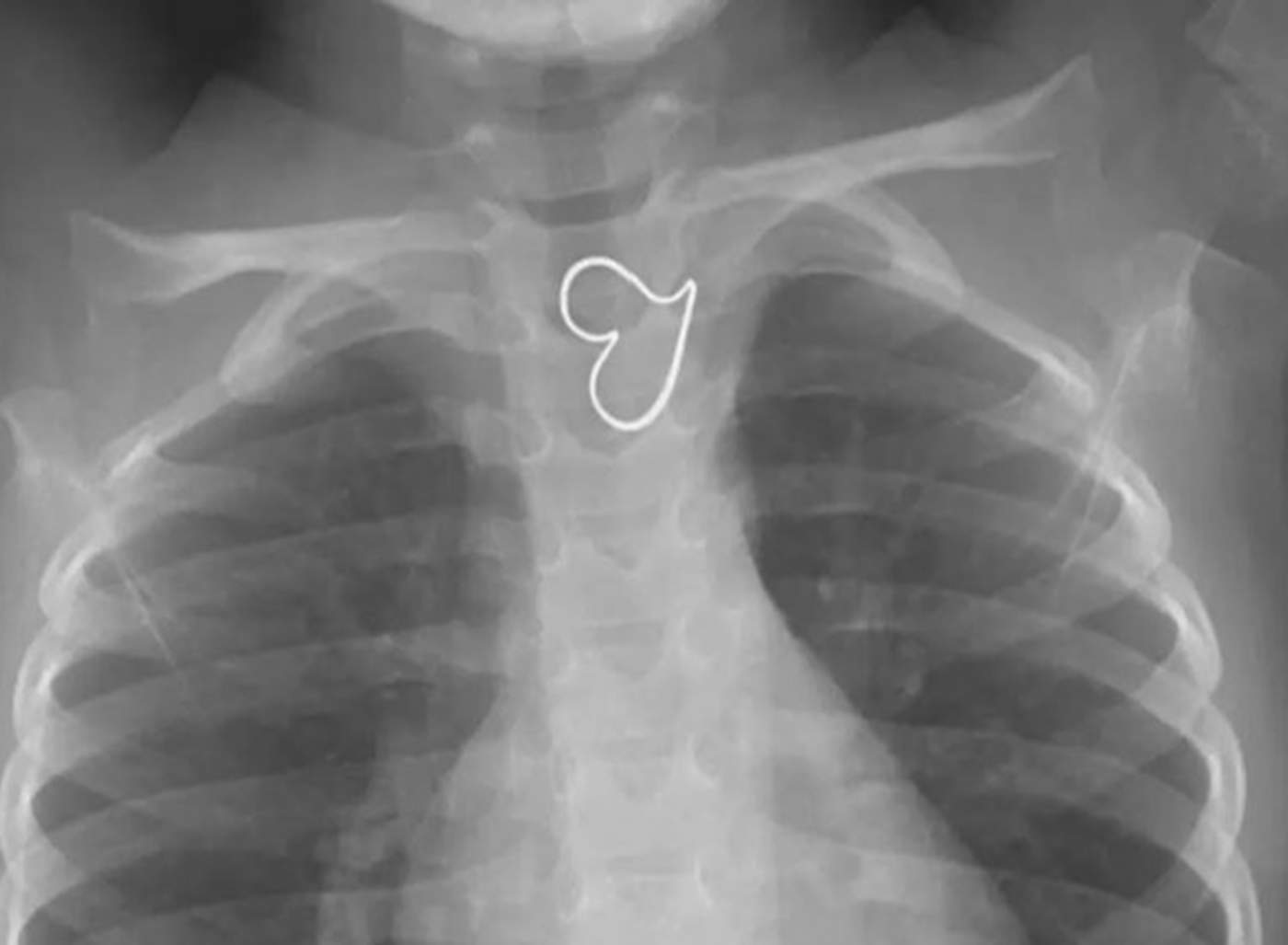 Aparece un ‘corazón perfecto’ en la radiografía de una niña