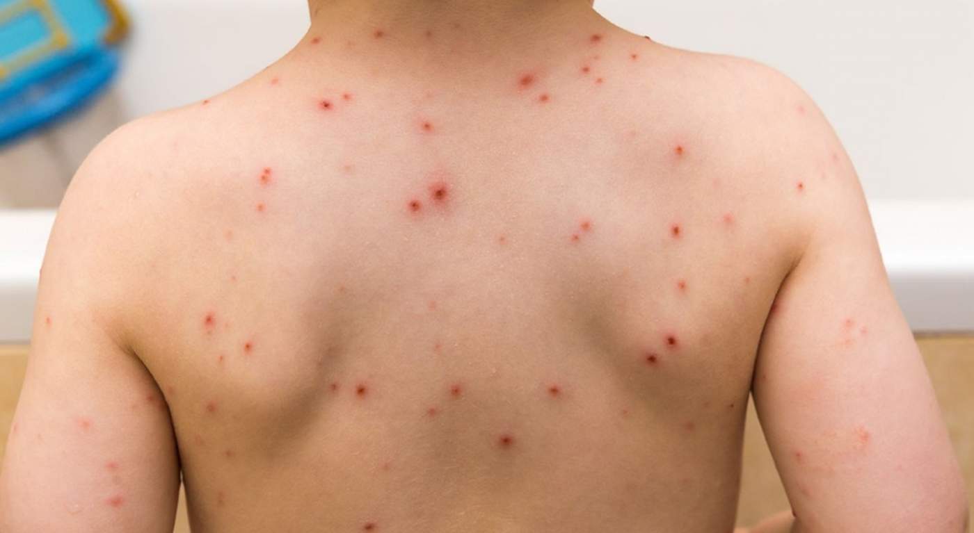 En la Comarca Lagunera no se ha generado un incremento en los casos de varicela. (INTERNET) 