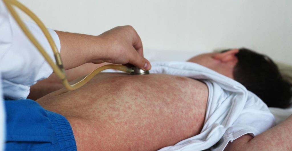 Casos de sarampión en EUA, por llegar a su máximo en 25 años