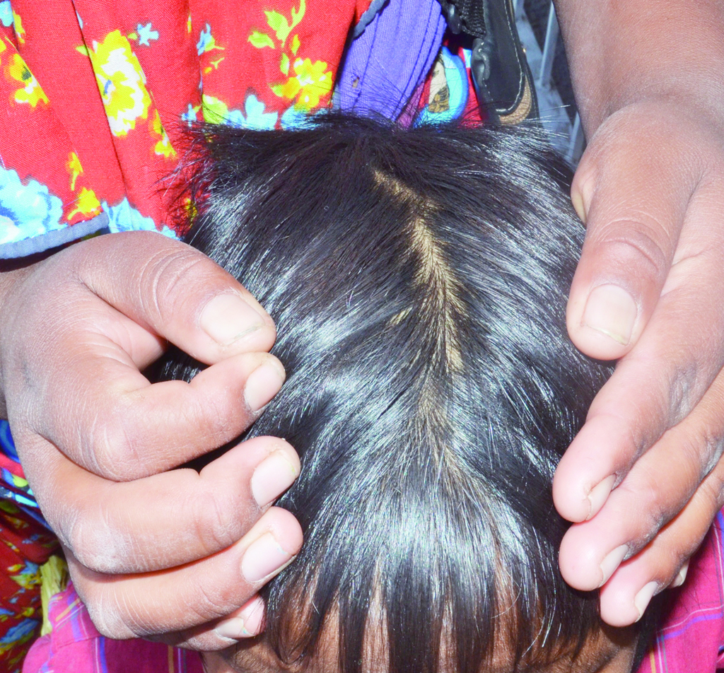 La pediculosis se caracteriza por un picor intenso que perjudica sobre todo al cuero cabelludo.