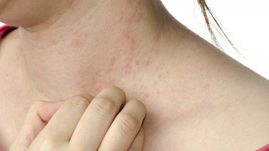 La exposición prolongada a factores que fomentan las alergias pueden ocasionar una mayor incidencia de dermatitis. (ARCHIVO)