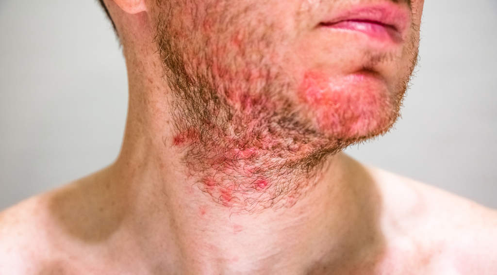 Uno de los problemas dermatológicos más frecuentes es la dermatitis atópica. (ARCHIVO) 