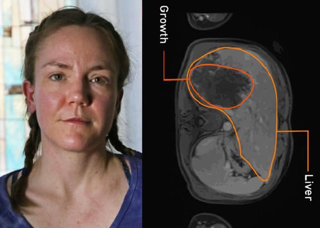 Al parecer, la mujer tuvo el parásito dentro de su cuerpo por 10 años. (INTERNET)