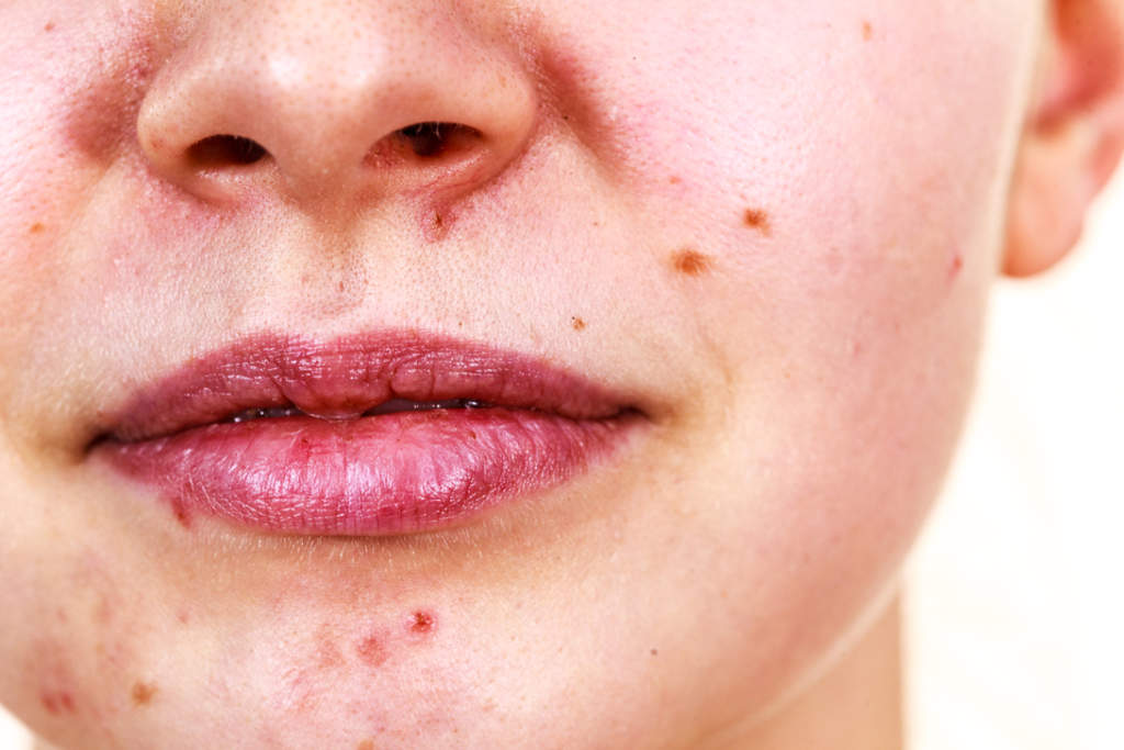 No es de sorprenderse que un medicamento efectivo contra el acné se haya popularizado entre los adolescentes que sufren efectos sobre la piel, autoestima y socialización, sin embargo, sus efectos secundarios pueden poner en riesgo la vida del paciente. (ARCHIVO) 