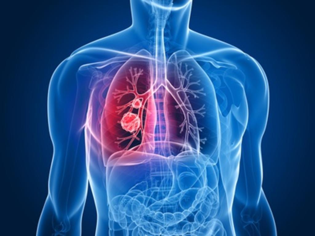 El cáncer de pulmón representa un 25% de todas las muertes por cáncer en el mundo, y es la principal causa de muerte por cáncer entre hombres y mujeres. (ESPECIAL) 