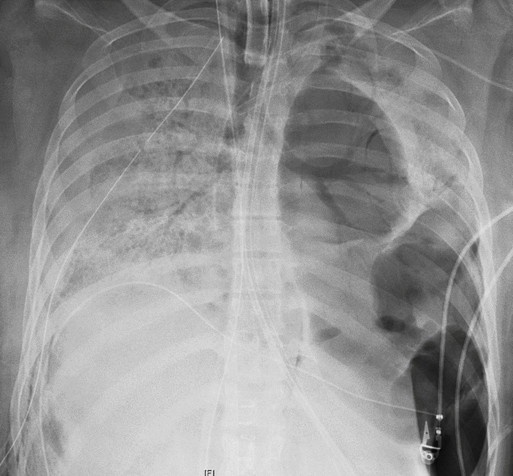 La paciente de Chicago, de veintitantos años, permaneció conectada a un respirador y a una máquina de derivación cardiopulmonar por casi dos meses antes de ser operada en el Hospital Northwestern Memorial.
(AP)