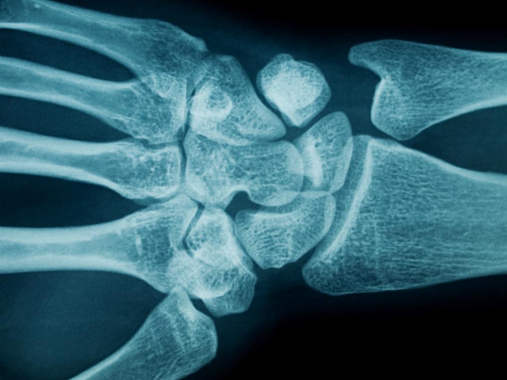 Una de las enfermedades que causa mayor impacto económico y social en el planeta es la osteoporosis. (ESPECIAL) 