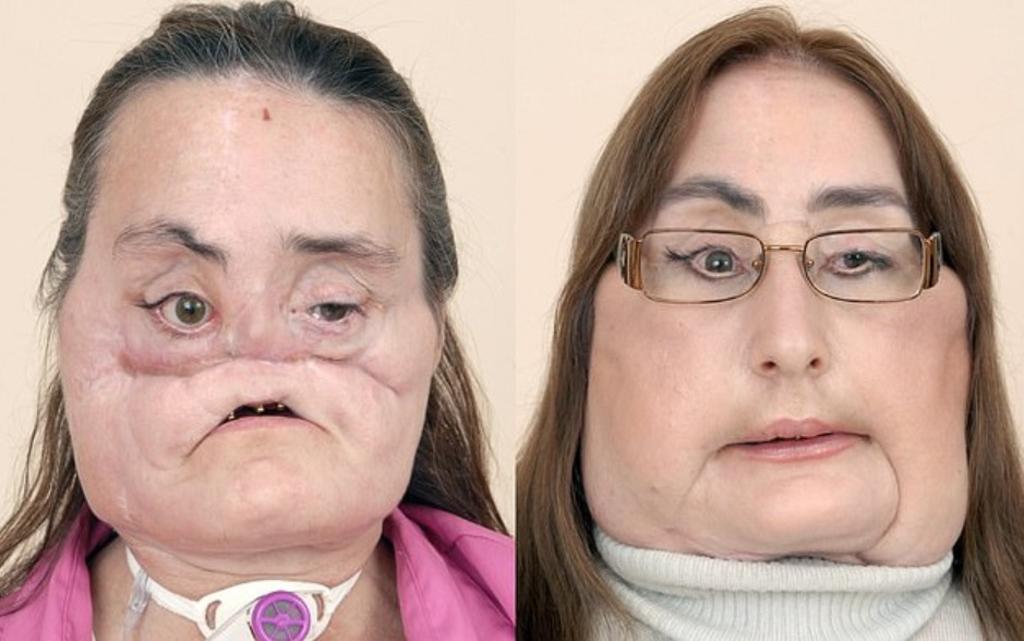 Destrozando completamente sus mejillas y la forma de su nariz, Connie tuvo que someterse a 80 cirugías antes de recibir el trasplante. (ESPECIAL)
