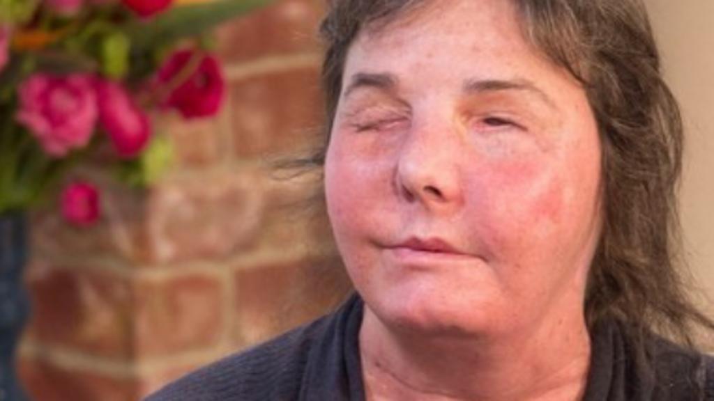 Por segunda vez en una década, una mujer de Nueva Hampshire recibe un trasplante de cara. Carmen Blandin Tarleton, que quedó desfigurada debido a un ataque de su exesposo, es la primera estadounidense y segunda persona en el mundo sometida a la operación, cuando el primer trasplante empezó a fallar después de seis años. (ESPECIAL) 