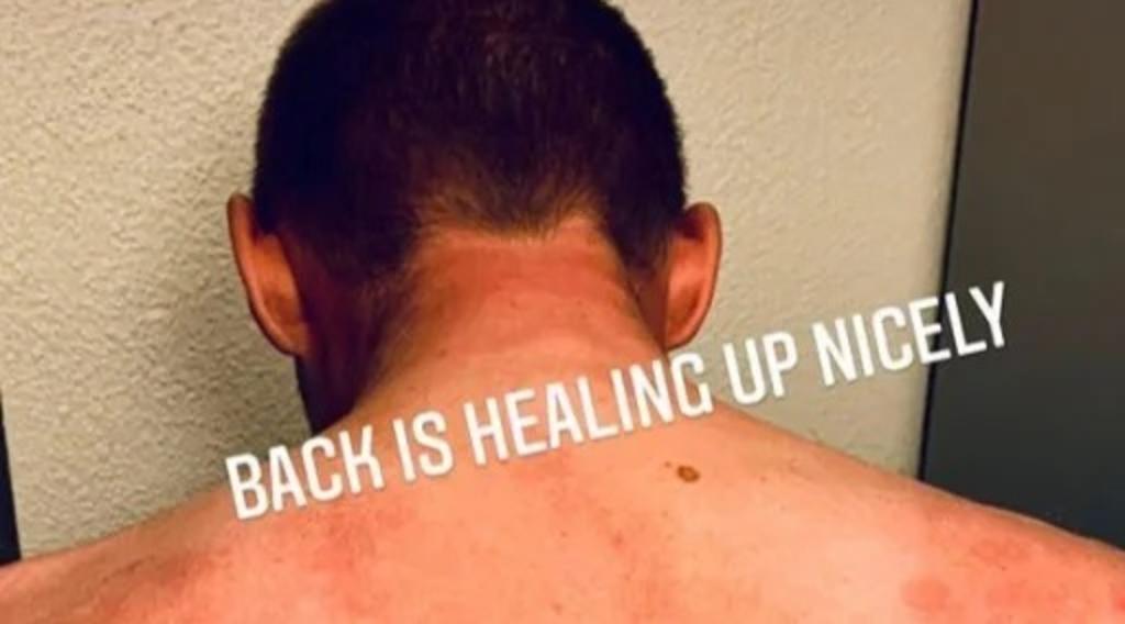 Por medio de Instagram el ciclista compartió una fotografía con hematomas en su espalda, resultado del impacto del granizo en ésta (CAPTURA) 