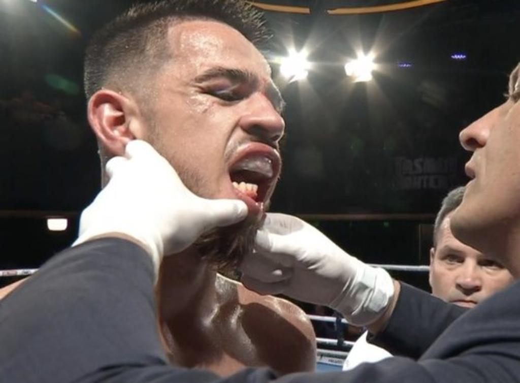 La lesión ocurrió durante su encuentro con Ben Mahoney en Australia, donde durante el segundo asalto recibió un duro golpe en el rostro, ocasionando sangrado en su boca. (Especial) 