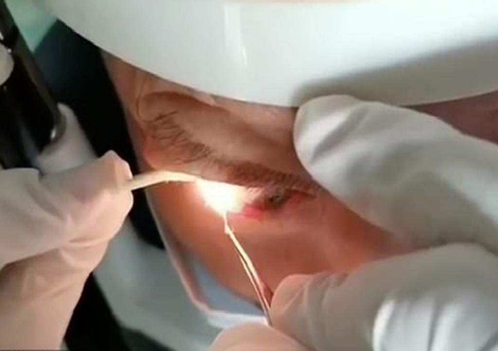 El paciente acudió al médico por molestias en el ojo. (INTERNET)