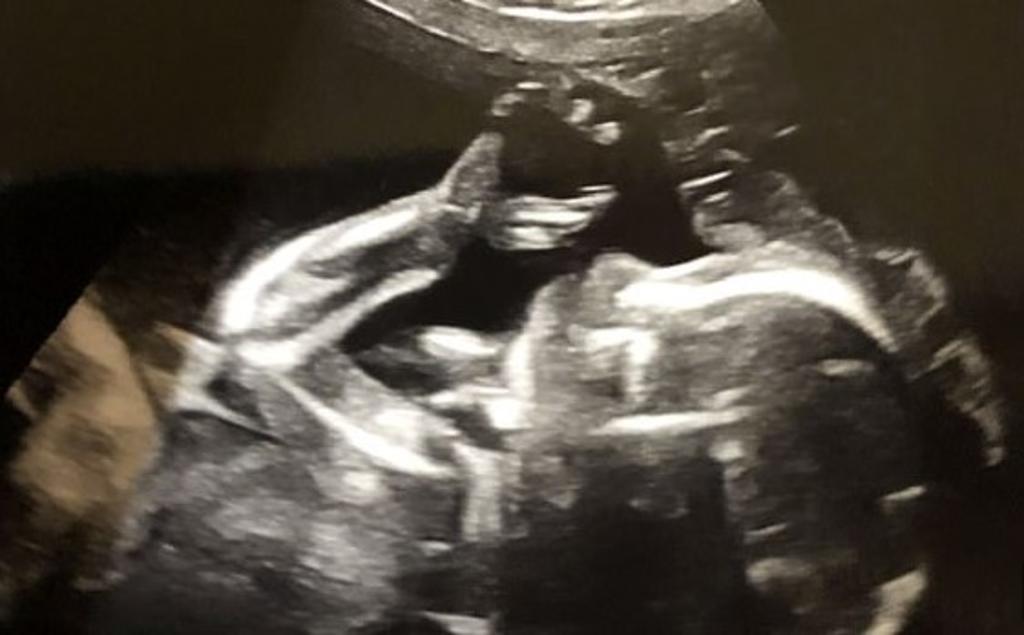 Una pareja quedó impactada luego de ver la fotografía de su bebé en el ultrasonido 4D lanzando la 'Britney señal', con la mamá primeriza asegurando que tendrá un 'remolino'. (Especial) 