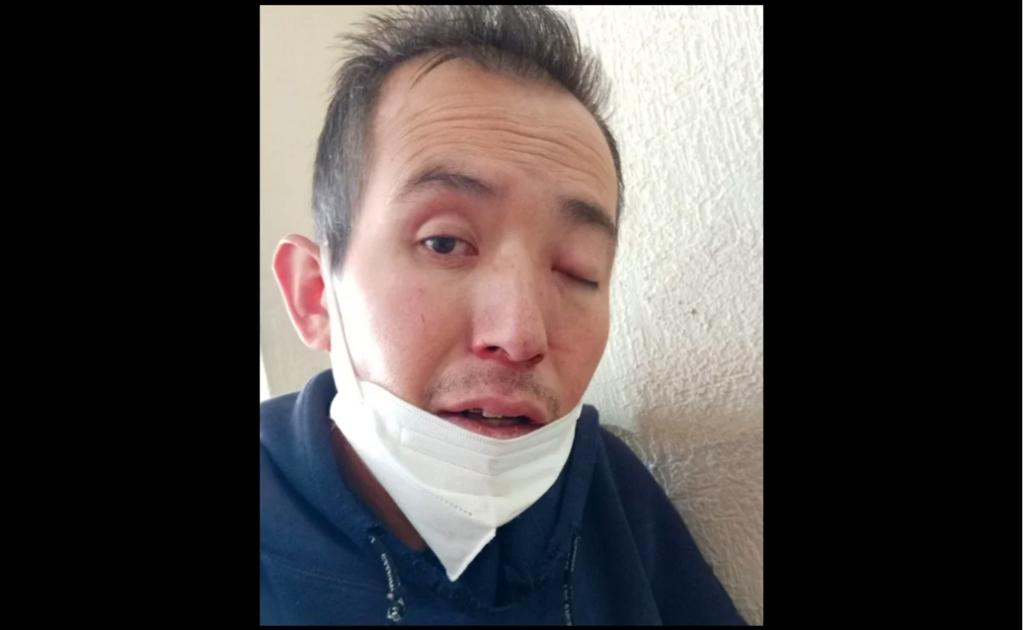 Gregorio Avendaño Jiménez, el joven que hace poco más de una semana se dio a conocer por ser el primer caso sospechoso de la infección del 'hongo negro' en México, falleció la mañana de este lunes en el Centro Médico Nacional La Raza, según informaron familiares. (ESPECIAL)