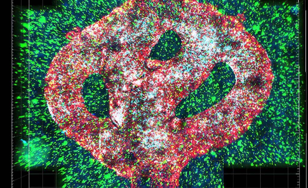 Con ayuda de una impresora 3D, investigadores de la Universidad de Tel Aviv, han creado la replica de un gliobastoma activo, uno de tumores cerebrales más letales, el cual ayudará a avanzar en la detección de tratamientos y el desarrollo de medicamentos (ESPECIAL) 