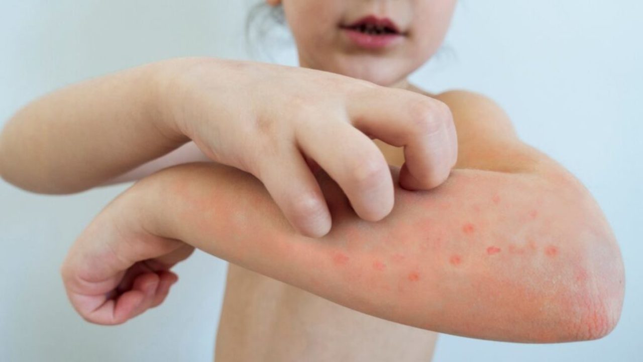A nivel país son 24 mil 702 los atendidos por este padecimiento causado por el virus varicela-zoster.