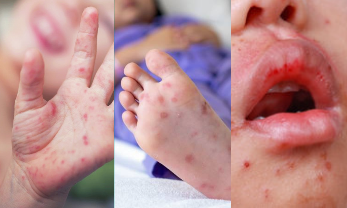 ¿Ardor y dolor? Puede ser la enfermedad pie-mano-boca