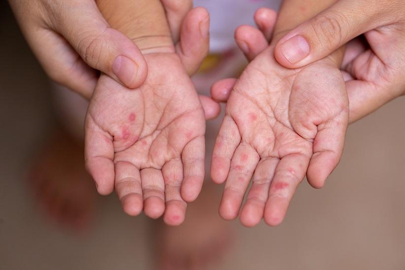 Confirman dos casos y dos sospechosos de sarampión en Coahuila, todos en menores de edad