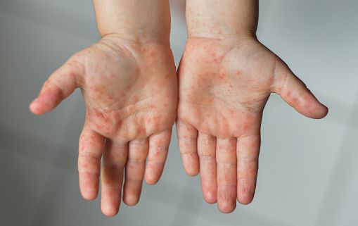Iniciarán cercos sanitarios en 16 escuelas en Piedras Negras, tras brote de sarampión