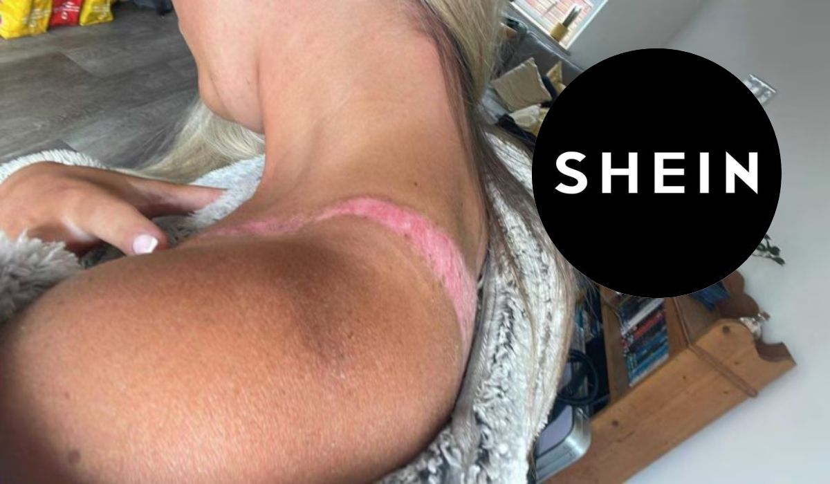 Joven sufre quemaduras tras usar un top de Shein durante sus vacaciones