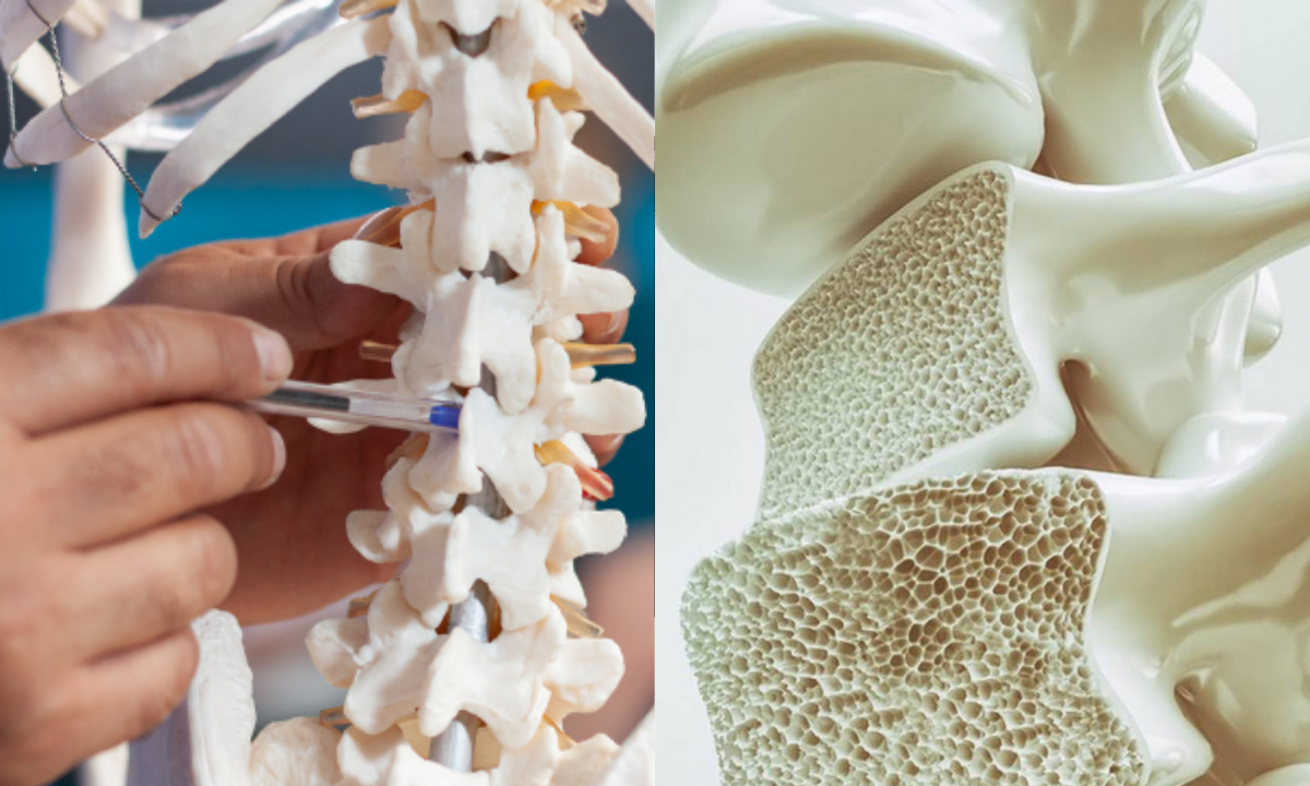 Mitos: osteoporosis y tercera edad